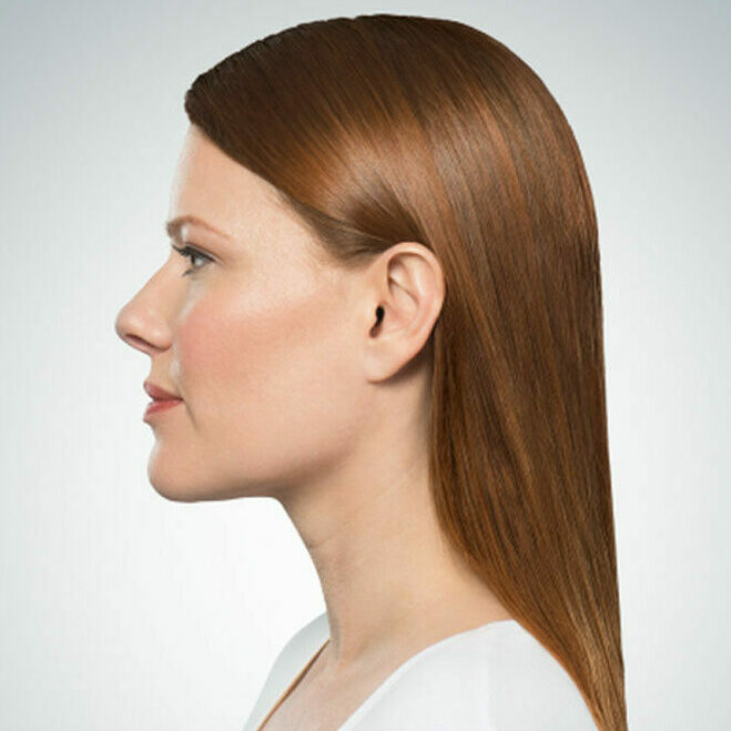 Kybella®